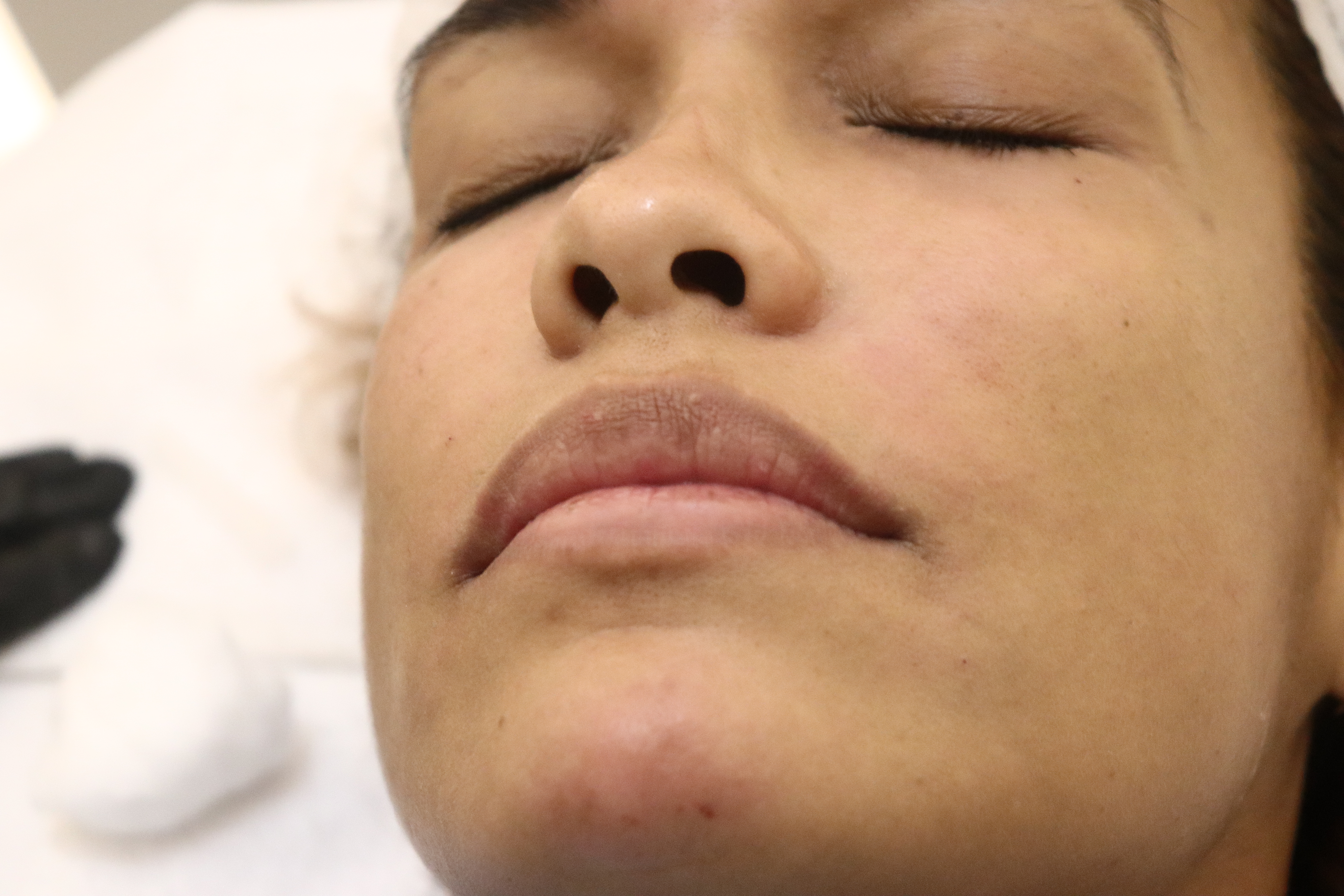 Facial result at Aura