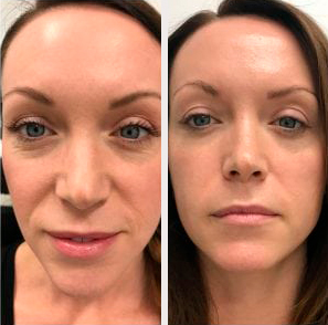 Non-surgical facial lifting