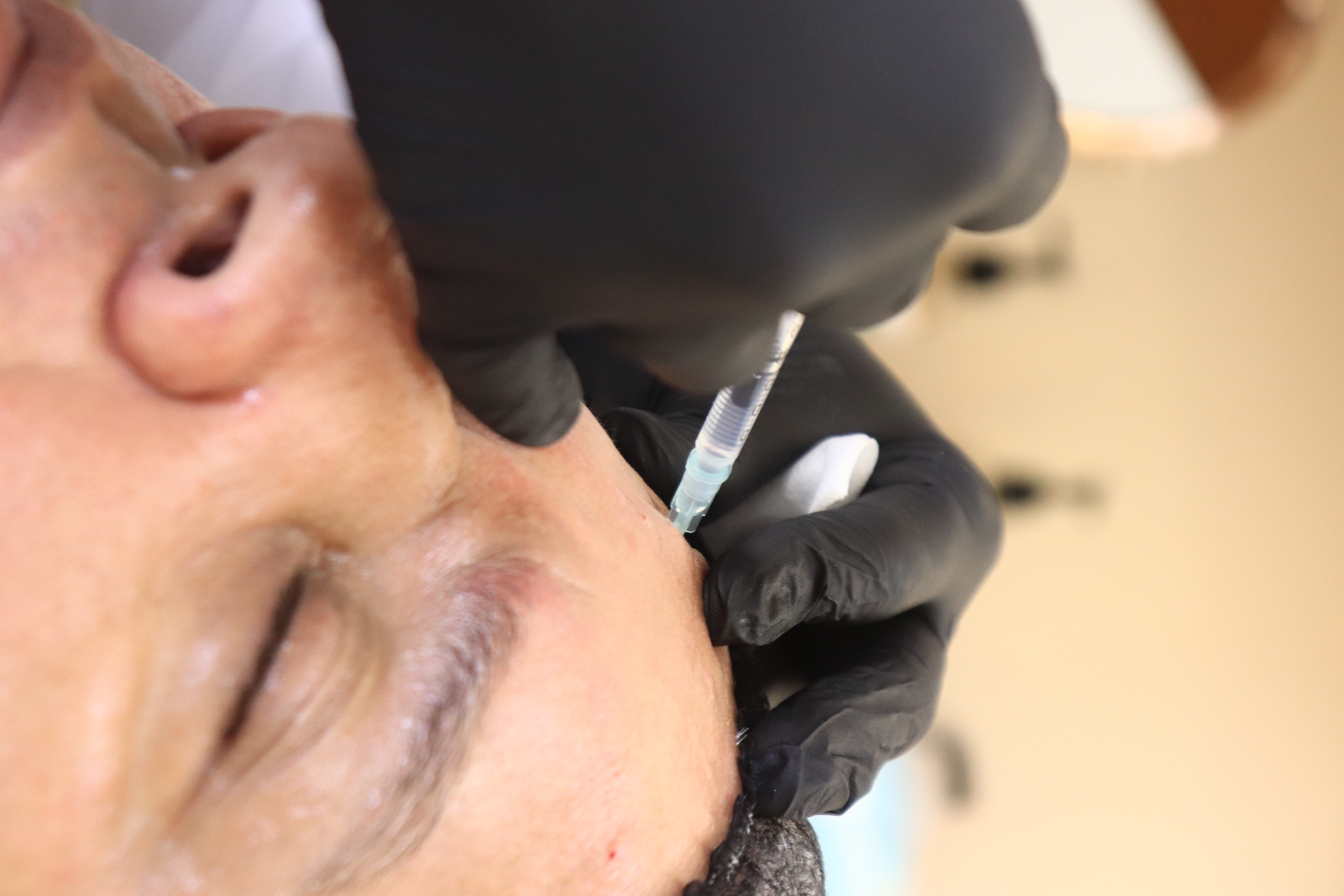 Botox treatment at Aura Aesthetics Center