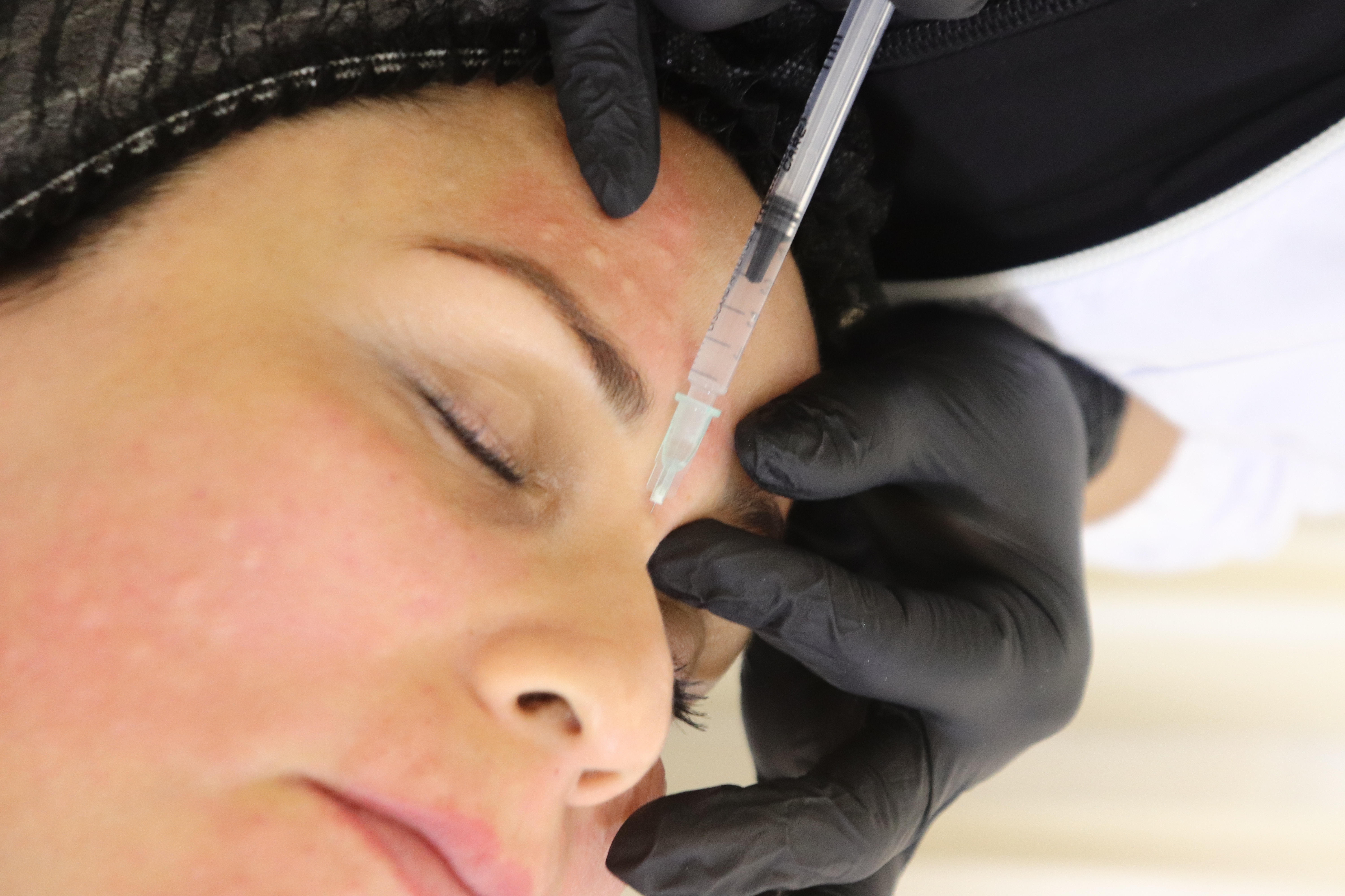 Collagen Biostimulators