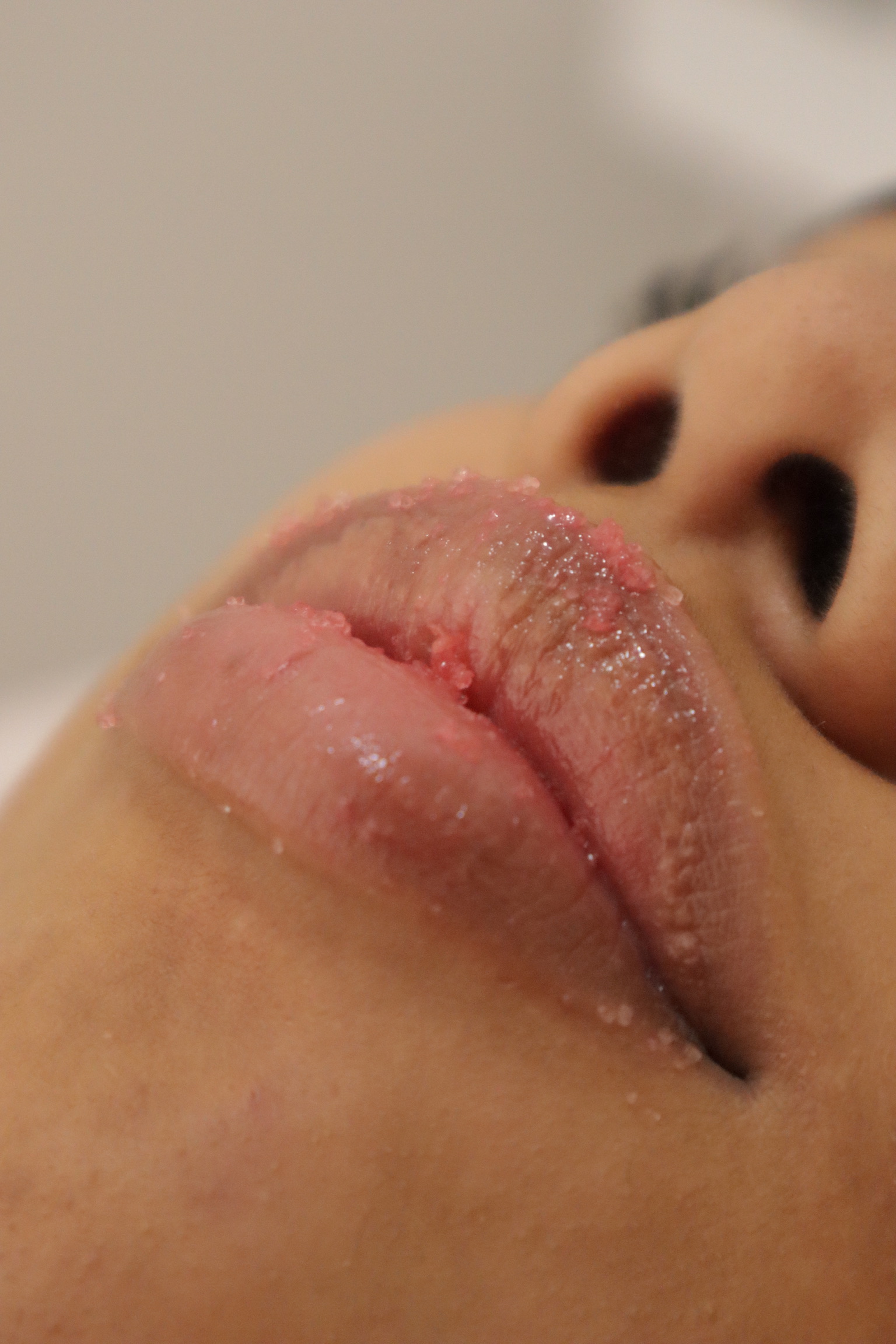 Hydralips treatment